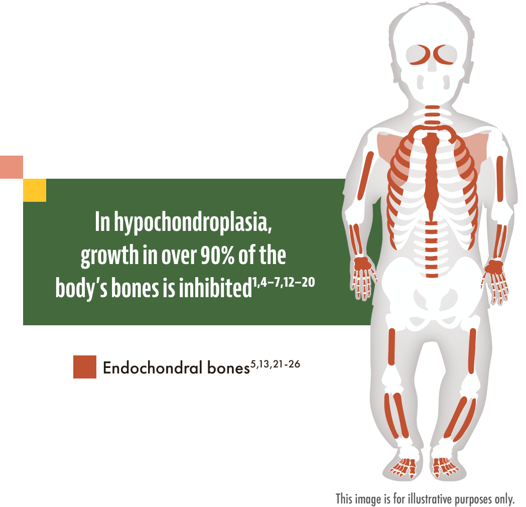 Medical graphic showing bones with inhibited growth from hypochondroplasia, a rare genetic skeletal dysplasia.